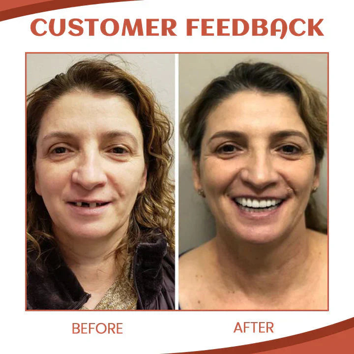 Silicone Denture Set ~ Achieve a natural, confident smile instantly~